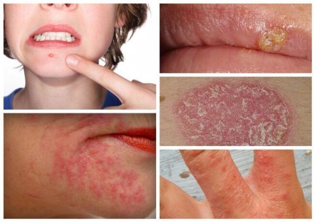 Dị ứng và các bệnh ngoài da là dấu hiệu của ký sinh trùng trong cơ thể