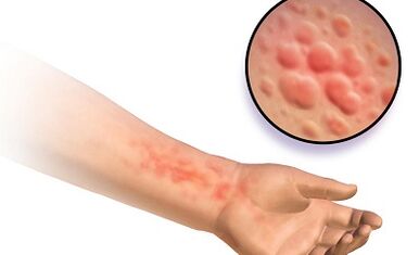 Biểu hiện của bệnh Schistosomosis ở người